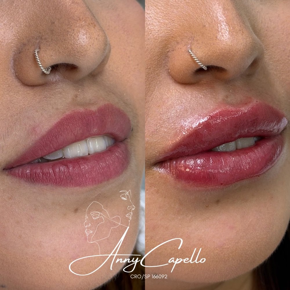 Resultado de preenchimento labial